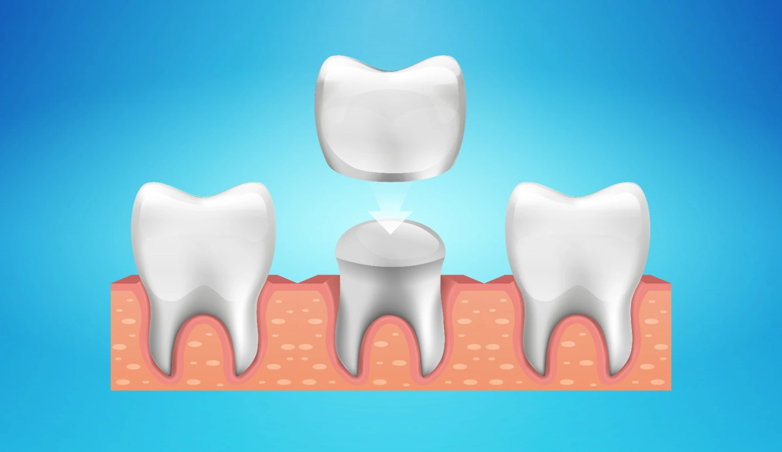 dental crowns in baniyas