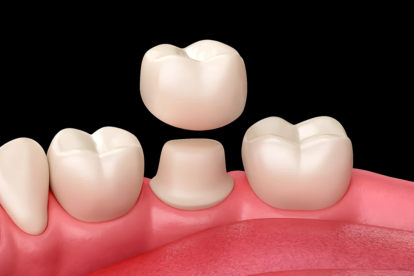 dental crown in baniyas