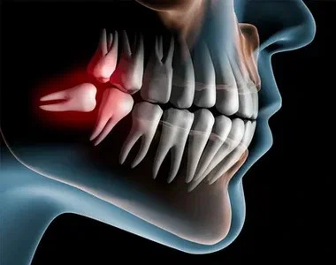 wisdom tooth removal x ray in baniyas