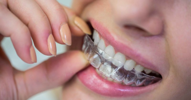 clear aligners in baniyas