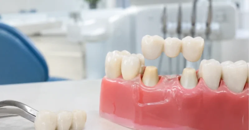 Dental bridge treatment in baniyas