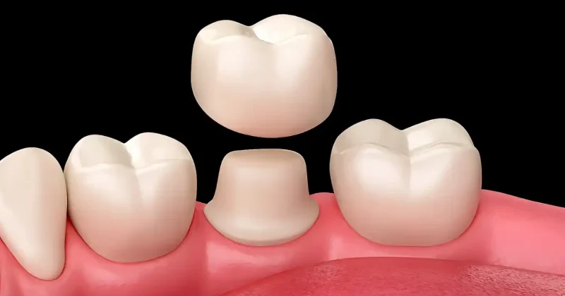 Dental Crown in Baniyas Abu Dhabi