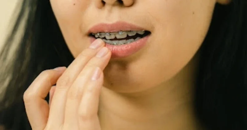 dental_braces_baniyas