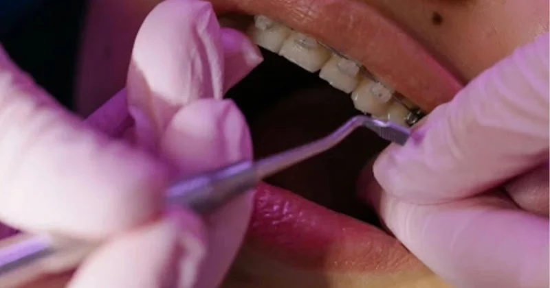dental_braces_treatment