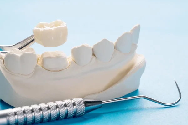 dental crown in baniyas