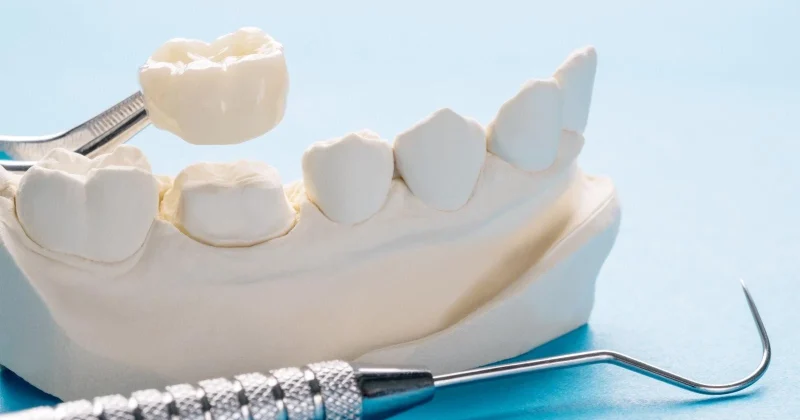 dental crown in baniyas