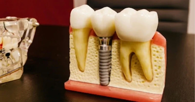 Dental implants in Baniyas, Abu Dhabi