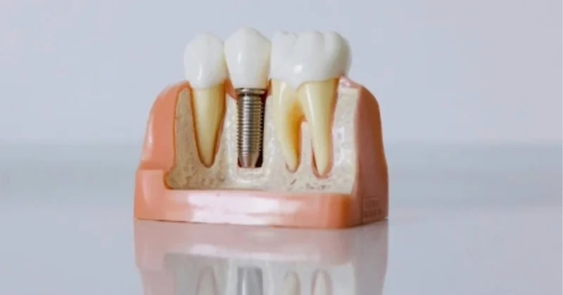 Dental implants in Baniyas, Abu Dhabi