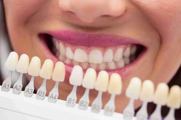 dental veneers in baniyas