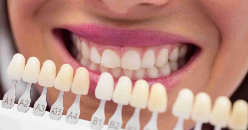 dental veneers in baniyas