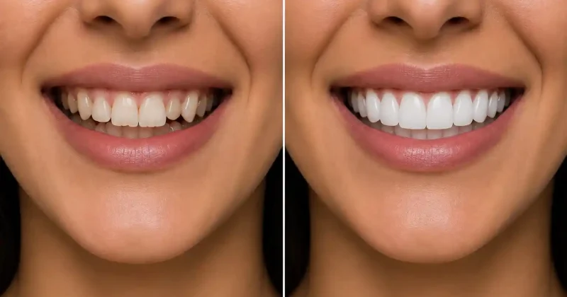 hollywood smile before and after