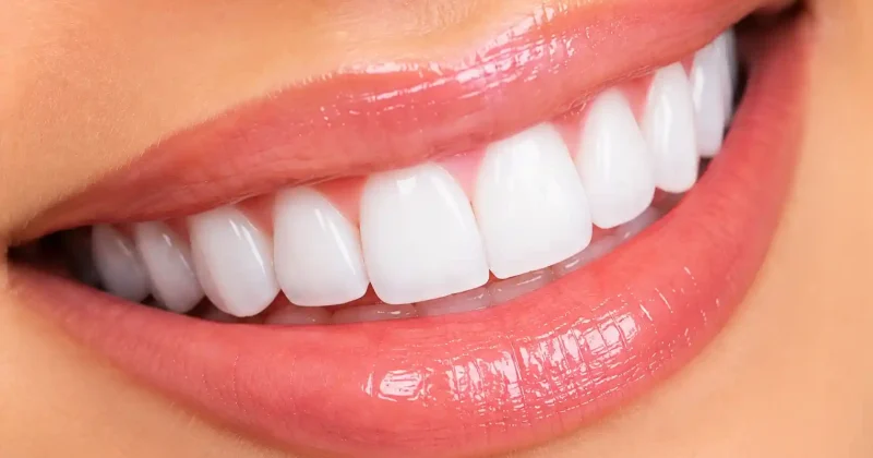 Hollywood smile design in Baniyas