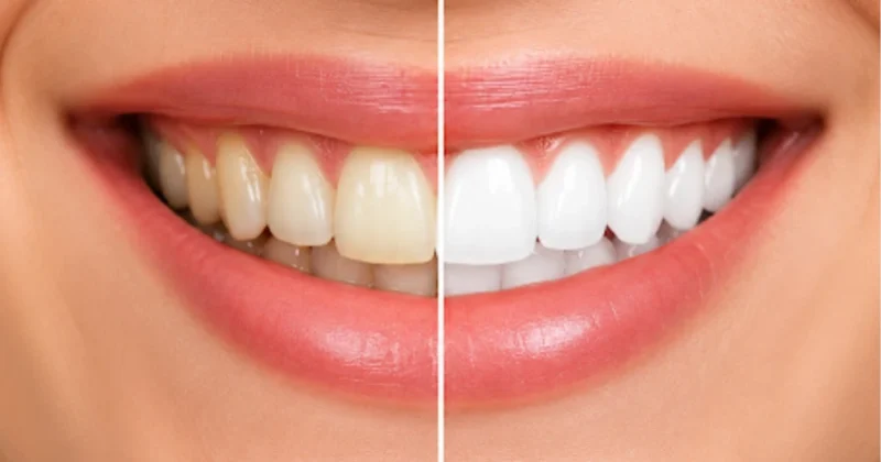 Teeth Whitening in Baniyas
