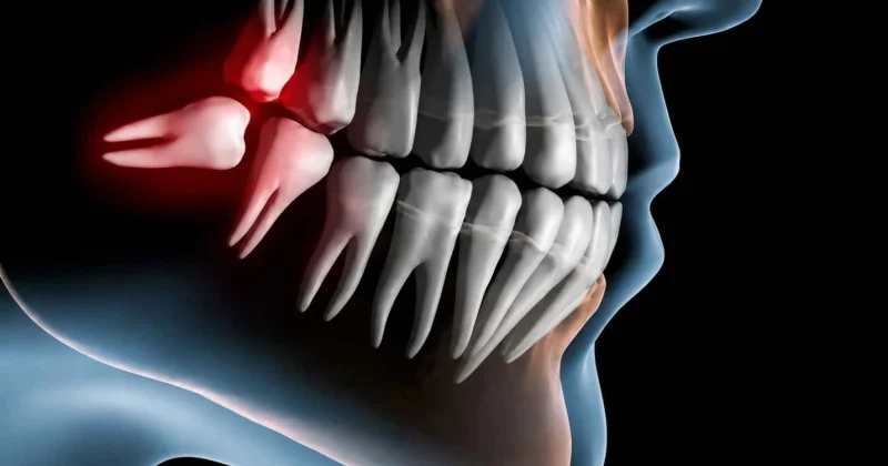 wisdom tooth removal x ray in baniyas